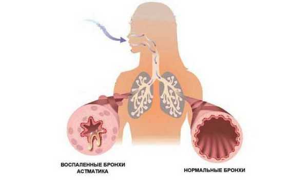 Бронхиальная астма