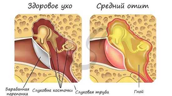 Отит - воспаление уха