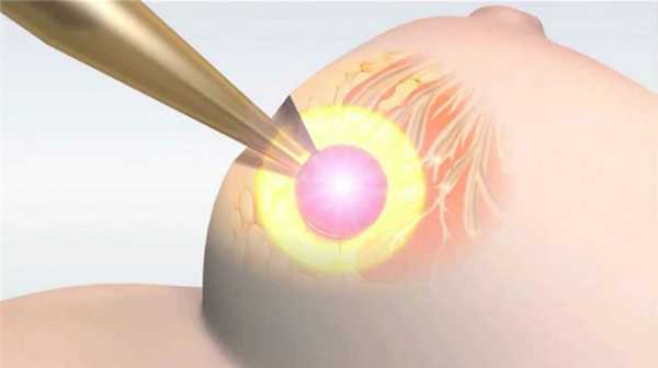 Лучевая терапия