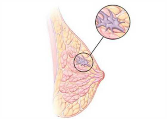 Карцинома груди