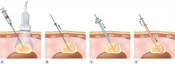 Склерозирование