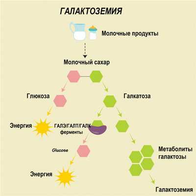 Галактоземия