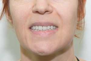 Последствия пародонтоза. Восстановление по протоколу Basal Complex FULL