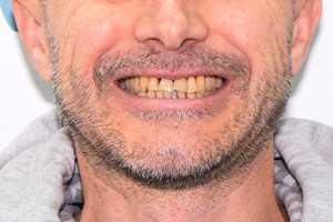 Базальная имплантация против генерализованного пародонтита