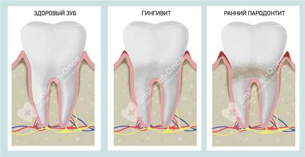 отличия гингивита от пародонтита