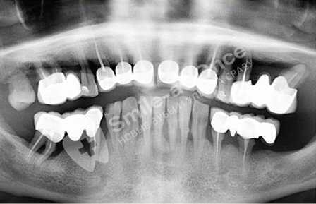 снимок средней стадии пародонтита