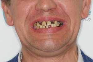 Basal Complex для нижней челюсти при пародонтозе