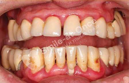 фото средней стадии пародонтита