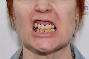 Последствия пародонтоза. Восстановление по протоколу Basal Complex FULL