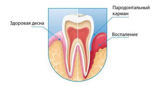 лечение пародонтальных карманов