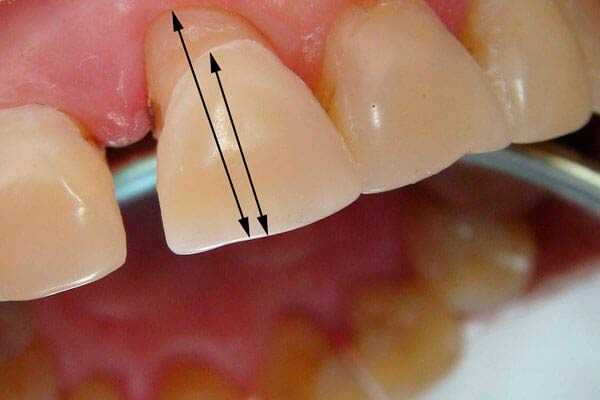 открытый кюретаж пародонтальных карманов