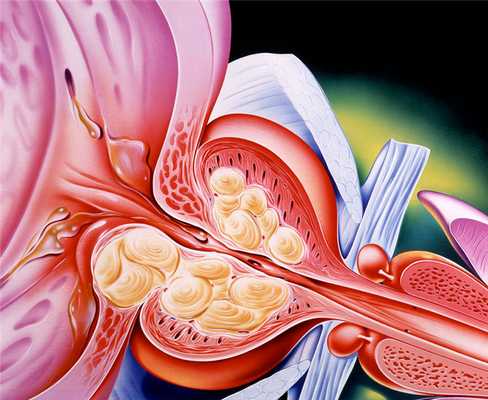 Аденома простаты