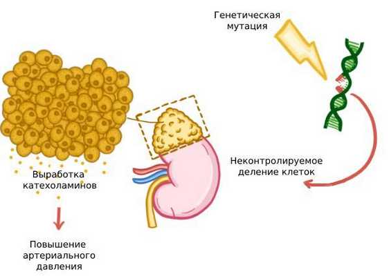Развитие феохромоцитомы