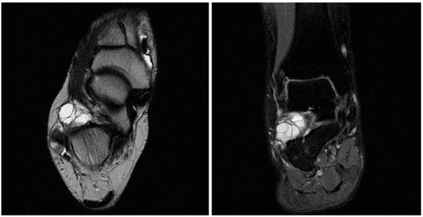 Ганглиевая киста (сухожильный ганглий)
