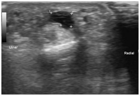 Ганглиевая киста (сухожильный ганглий)