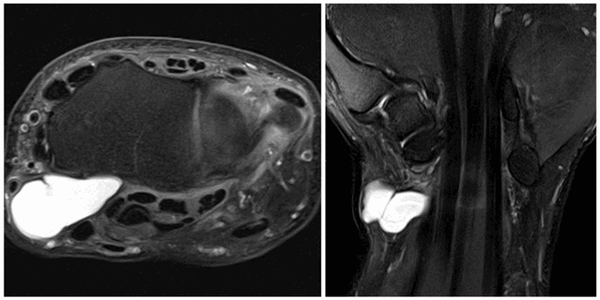 Ганглиевая киста (сухожильный ганглий)