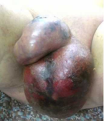 Гангрена Фурнье клиническая или развернутая стадия