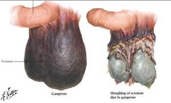 Гангрена Фурнье пример