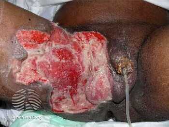 Гангрена Фурнье пример1