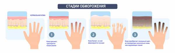 Обморожение.jpg