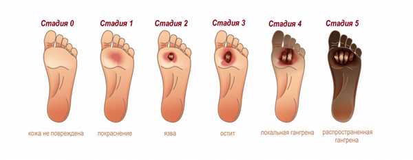 Сухая гангрена