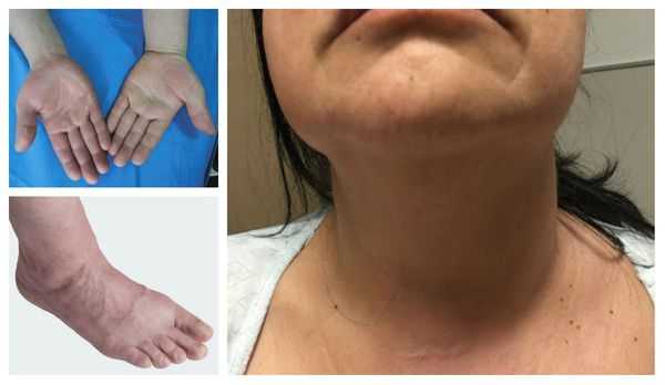 Симптомы тромбоза конечностей