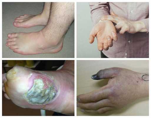 Симптомы влажной гангрены