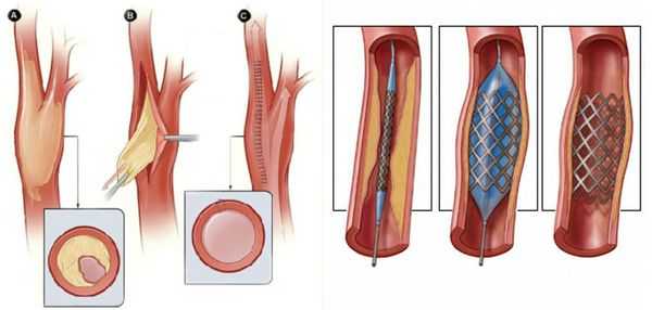 Удаление закупорки артерии/аутовенозное шунтирование