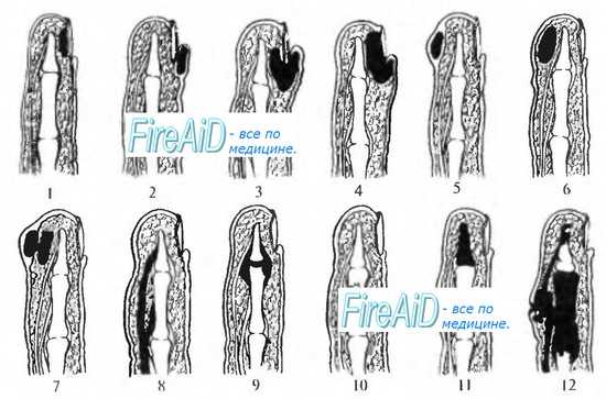 Панариции по В.К. Гостищеву