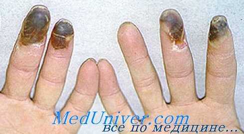 Гангрена Рейно