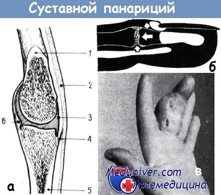 Суставной панариций