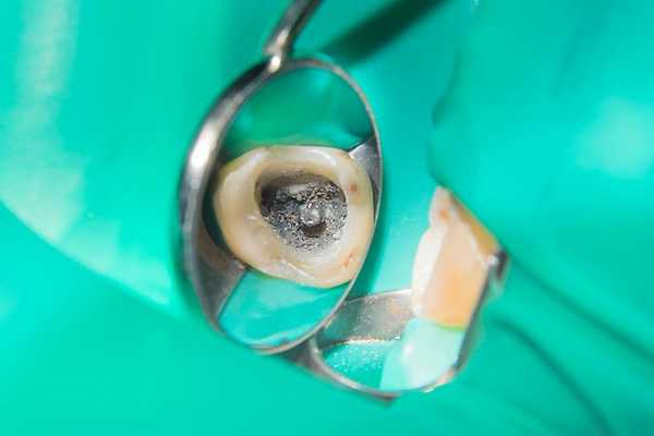 Гангренозный пульпит