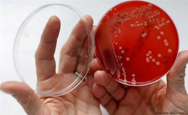 Гарднереллез: причины заболевания, диагностика, последствия и лечение