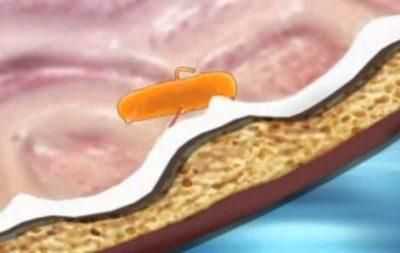 Сальмонелла в жкт