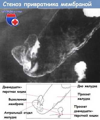 Стеноз привратника как показание к гастроеюностомии