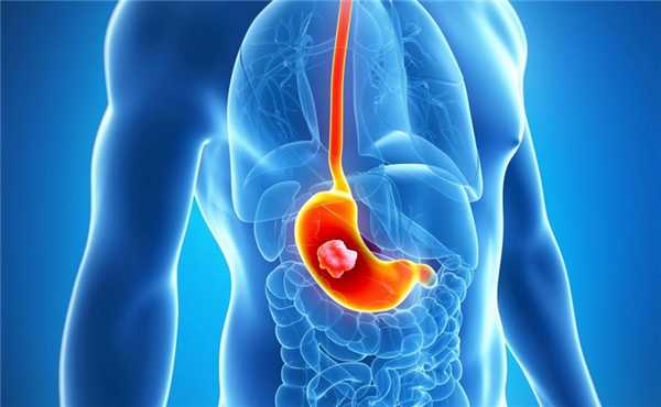 Еюностомия при онкологических заболеваниях