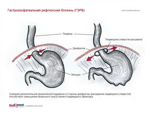 ГЭРБ (гастроэзофагеальная рефлюксная болезнь). Роль диафрагмы