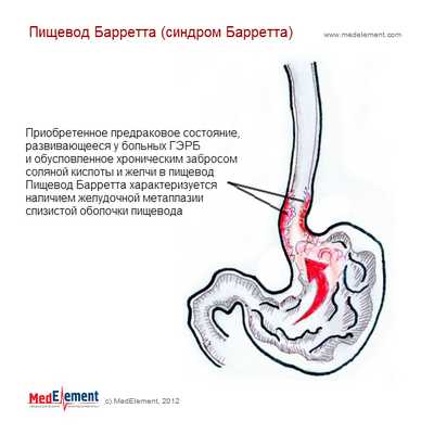 Пищевод Барретта (синдром Барретта)