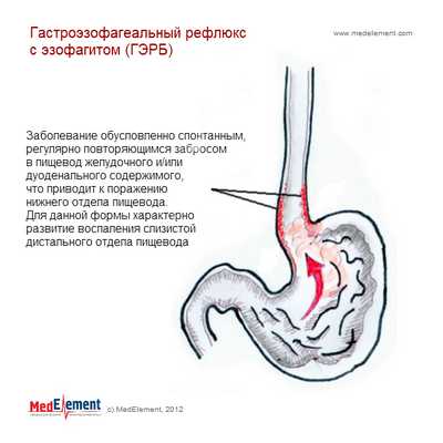 ГЭРБ с эзофагитом (гастроэзофагеальная рефлюксная болезнь)