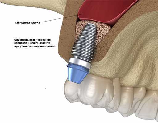 shutterstock_1377554240 - импланты.jpg