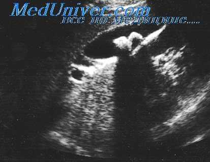 декомпрессия