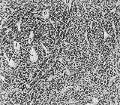 Рис. 1. Микроскопическая картина дифференцированной гемангиоперицитомы: сосуды капиллярного типа (1), окруженные веретенообразными клетками (2).