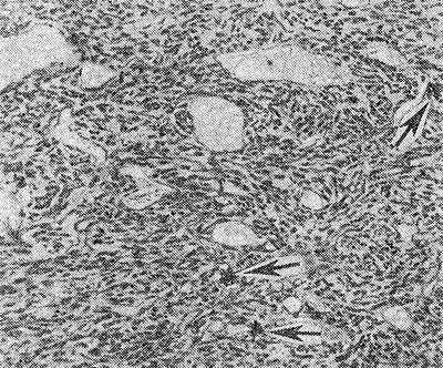 Рис. 2. Микроскопическая картина недифференцированной гемангиоперицитомы: видны фигуры деления (указаны стрелками).