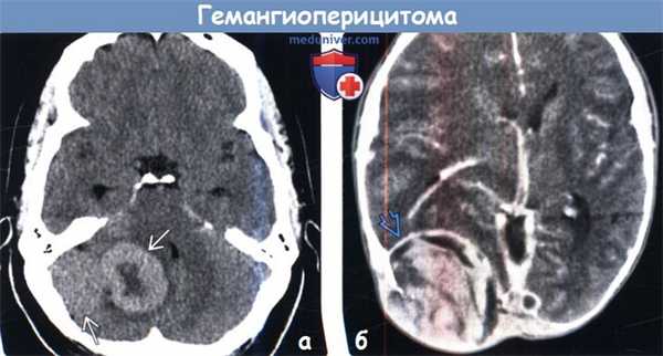 Гемангиоперицитома на КТ