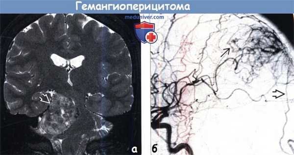 Гемангиоперицитома на МРТ