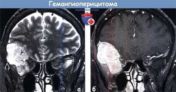 Гемангиоперицитома на МРТ