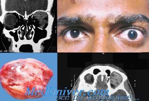 Гемангиоперицитома орбиты глаза