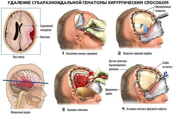 Хирургическое удаление гематомы