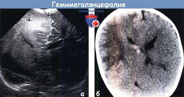 Гемимегалэнцефалия на УЗИ, КТ