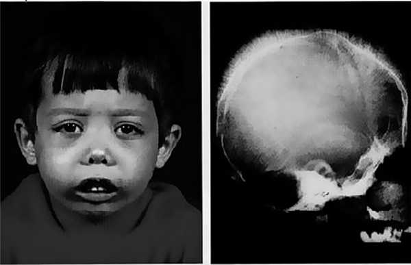 Талассемия у ребенка